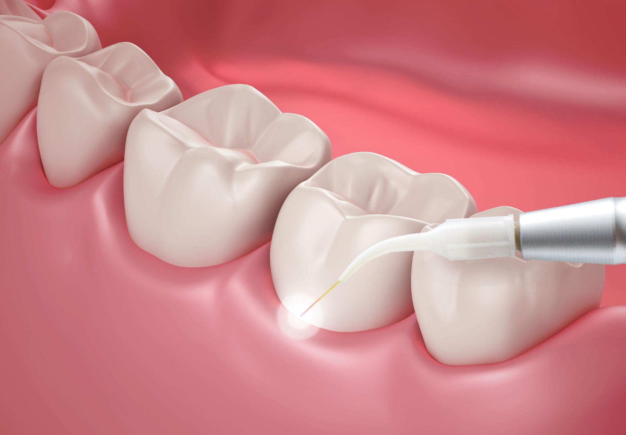 An image of laser gum contouring