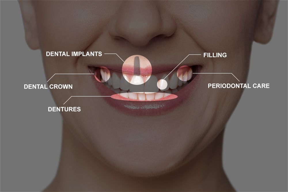 illustration of full mouth reconstruction