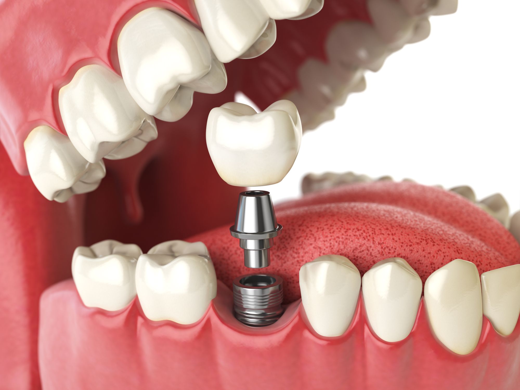 Implant-supported crown